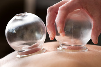 cupping acupuncture